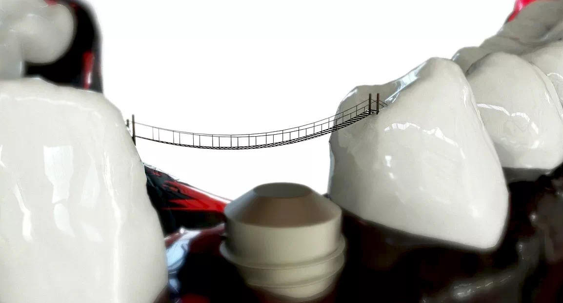 치아보험 임플란트 면책기간 놓지면 손해 보는 이유 3 치아보험 임플란트 면책기간